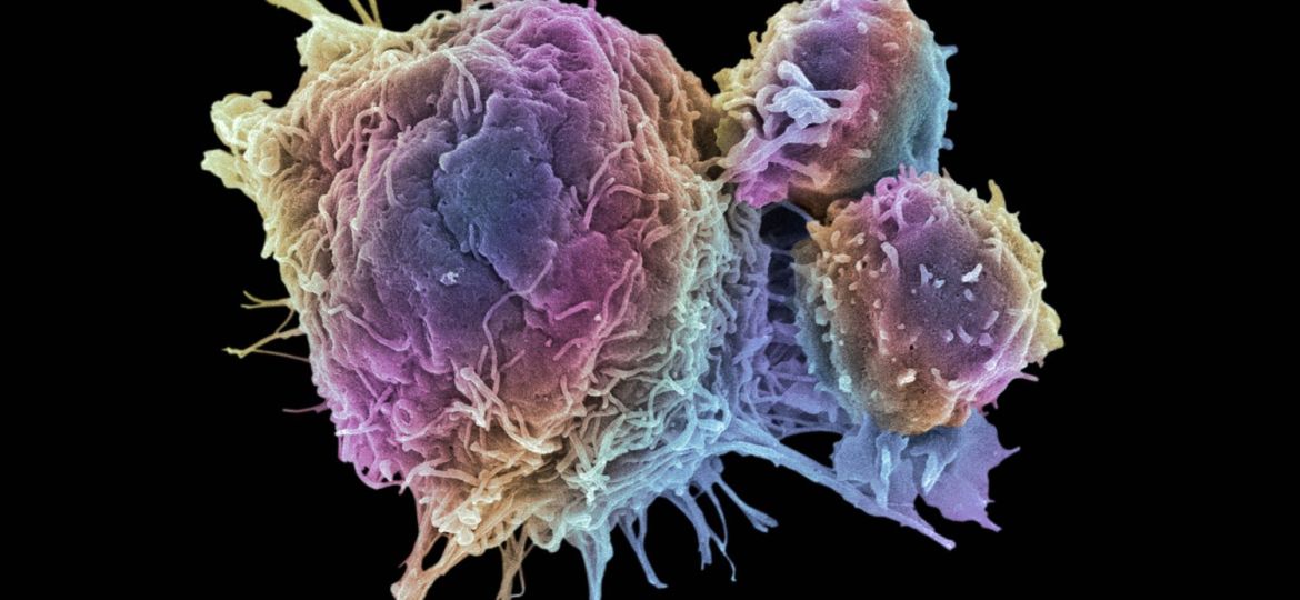 cancer_cell_and_T_lymphocytes-5a28416422fa3a0037111149