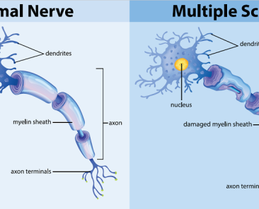 mulitple-sclerosis-inset