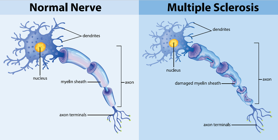 mulitple-sclerosis-inset