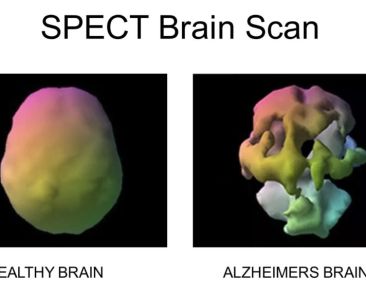 spect-brain-scan-1024x576