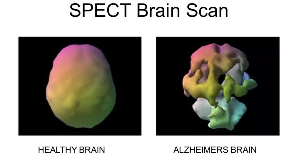 spect-brain-scan-1024x576