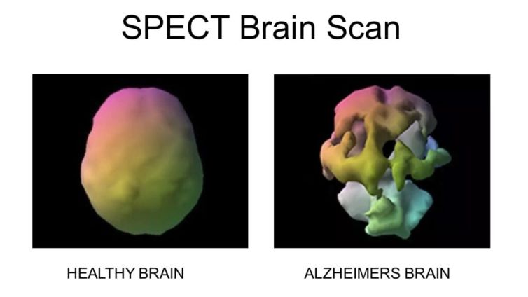 spect-brain-scan-1024x576